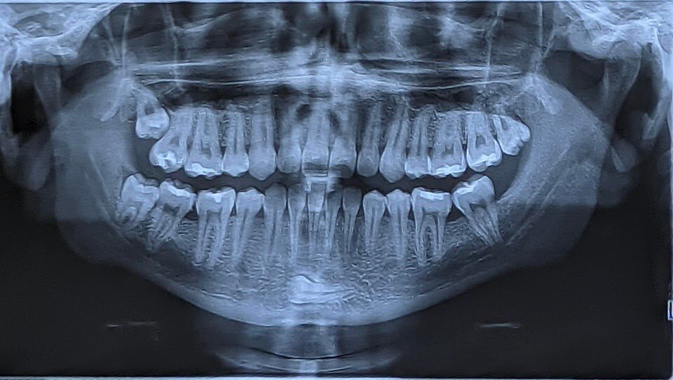Рентген челюсти фото