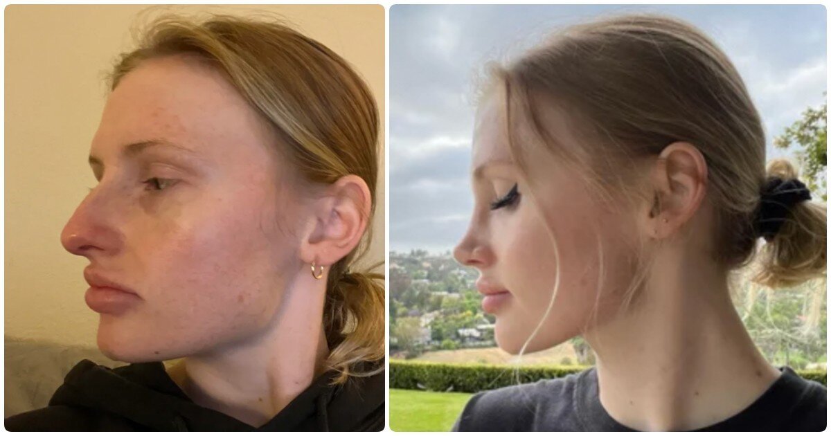 Елена воробей до и после ринопластики фото