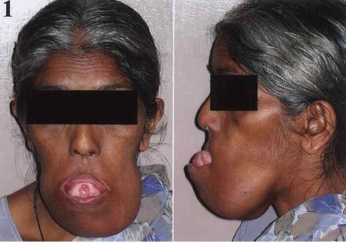 Амелобластома у людей (3 фото)