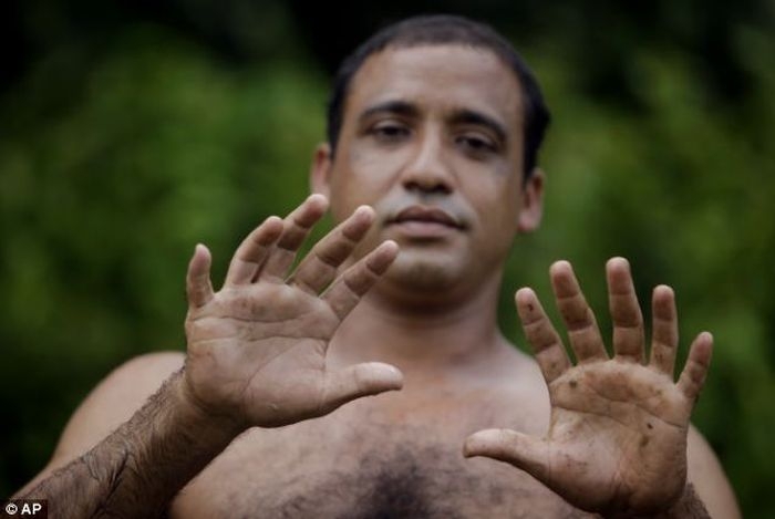 A Man With 24 Fingers 