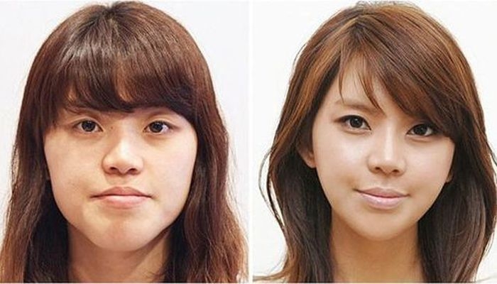 Plastic surgery in South Korea: before and after