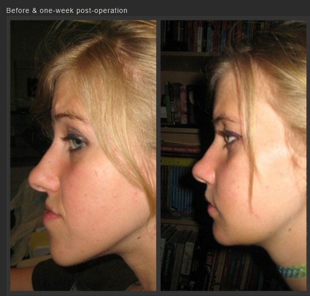 Life Changing Jaw Surgery