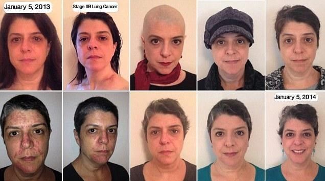 Борьба с раком в фотографиях: от поставленного диагноза до ремиссии