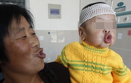 Редчайшее генетическое заболевание китайской малышки