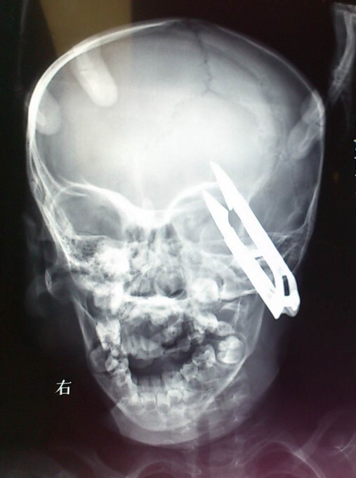 Малыш пробил голову ножницами