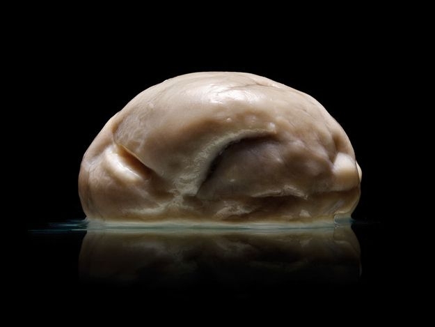 Мозг человека, страдающего лиссэнцефалией