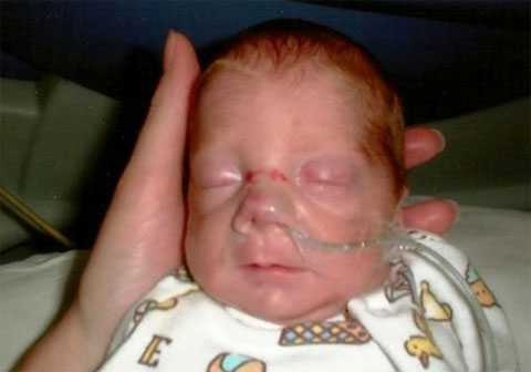 На носу у новорожденной выросла огромная фиолетовая опухоль