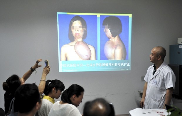 Китайцы вырастили на груди девушки новое лицо