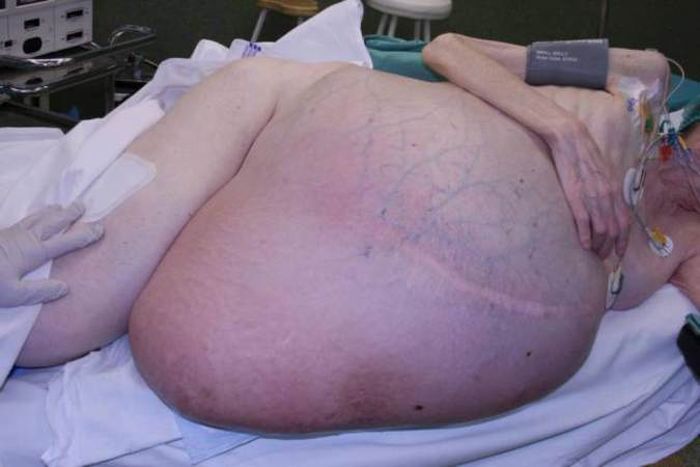 Из женщины извлекли опухоль весом в 36 килограммов 