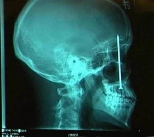 Рентгеновский снимок, который шокируют Вас