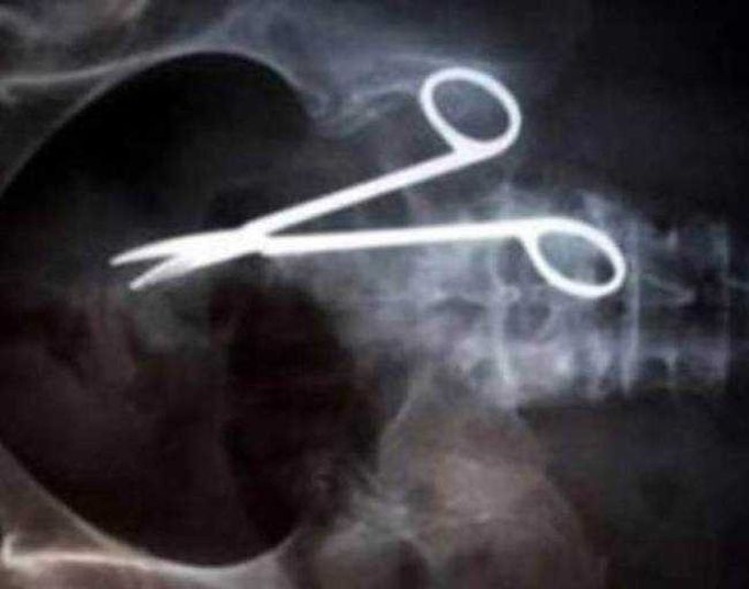 Мужчина 9 лет страдал из-за зажима, забытого в нем хирургами