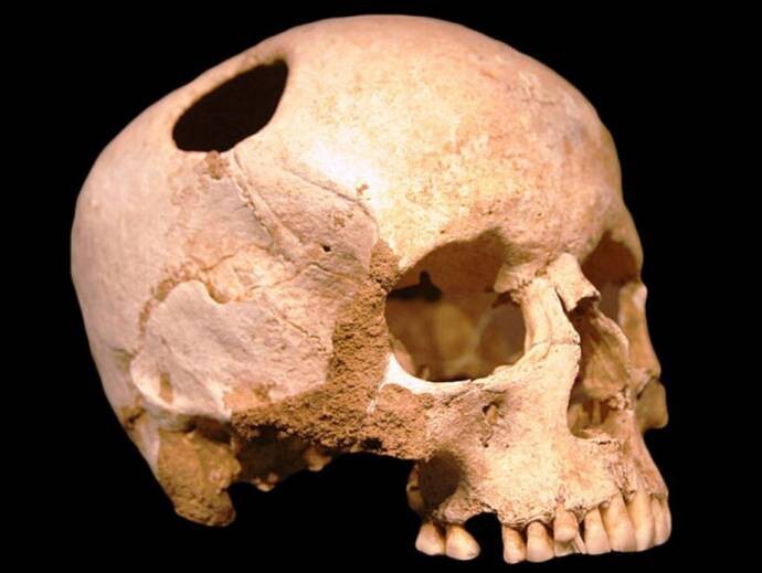 Три тысячи лет назад на Алтае делали сложные операции на мозге