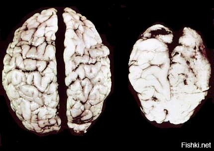 Мозг нормального человека и мозг алкоголика