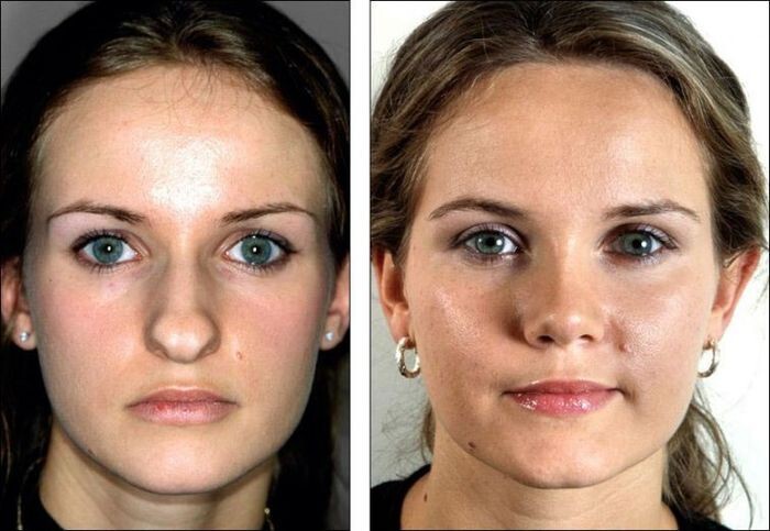 Как сильно пластика носа может изменить внешность человека