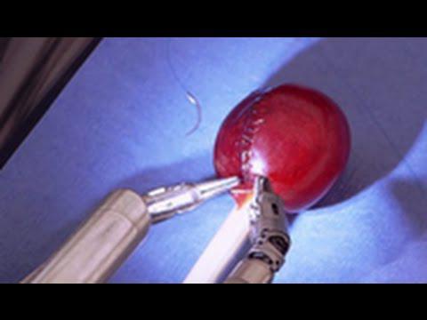 Робот выполняет операцию по сшиванию повреждённой виноградины