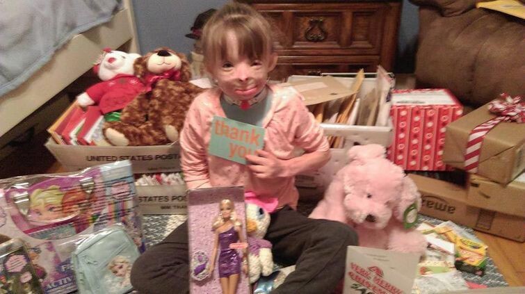 Обгоревшая девочка, потерявшая семью в пожаре, получила миллион рождественских открыток