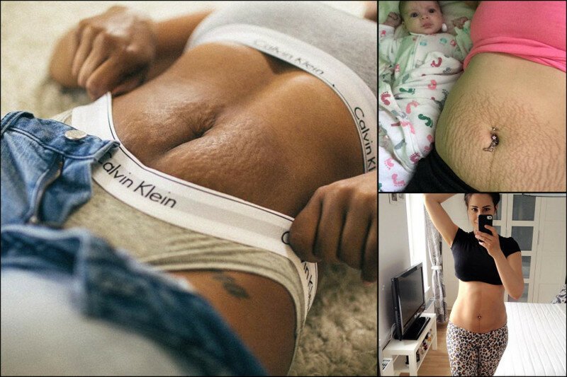 15 фото и историй женщин после беременности, которые мотивируют любить свое тело
