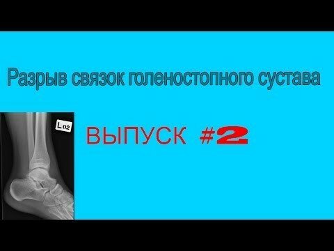 Разрыв связок голеностопного сустава. Лечение. Часть 2