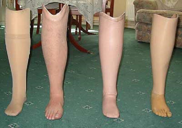 Служба ветеранов «АТО» просит не делать инвалидам ВСУ протезы из пластиковых крышечек