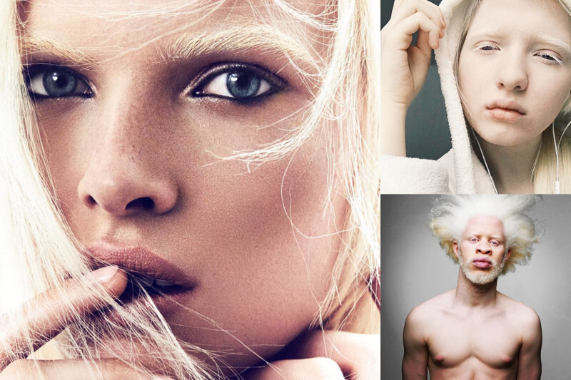 13 моделей-альбиносов, которые произвели фурор в мире моды