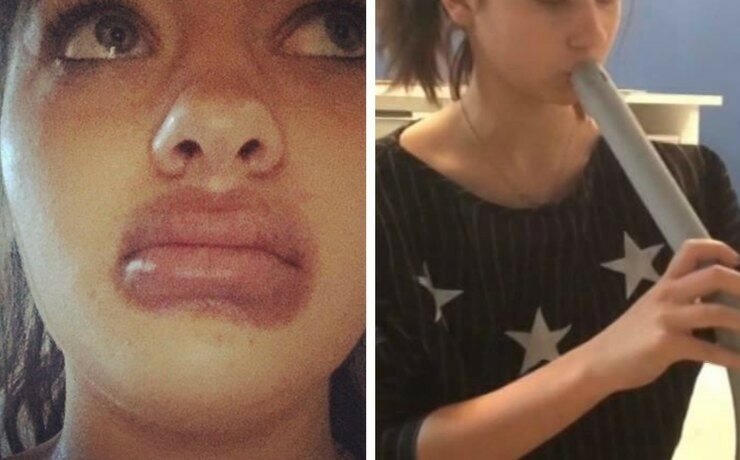 19-летняя ростовчанка попыталась увеличить губы пылесосом
