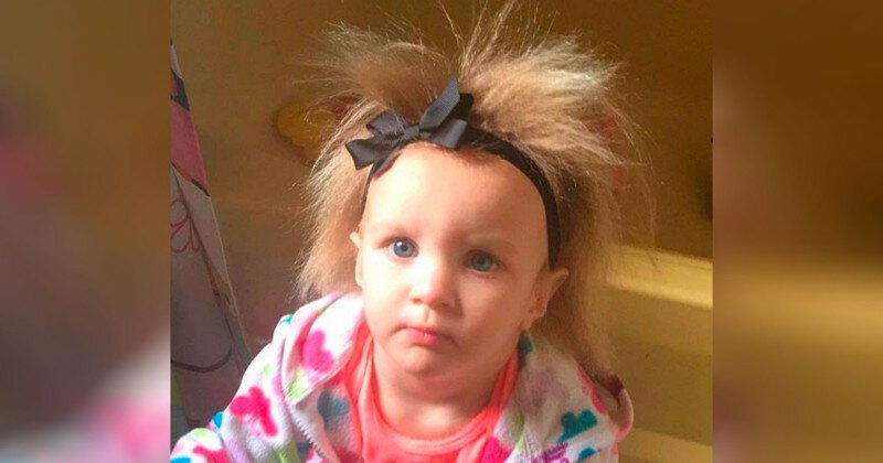 Малышке нельзя расчёсывать волосы из-за редкого заболевания, но ей это нравится