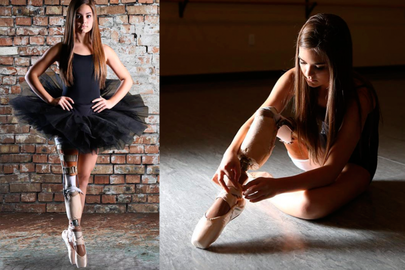 Даже с ампутированной ногой она исполнила свою мечту и стала… балериной!