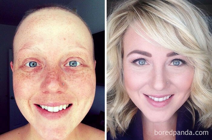 Люди, победившие рак: поразительные фото до и после