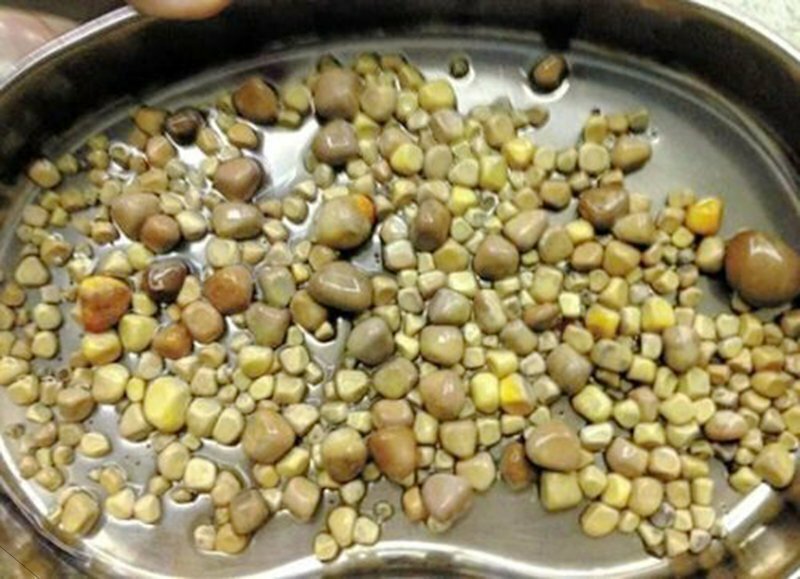 У любителя тофу врачи удалили 420 камней из почек