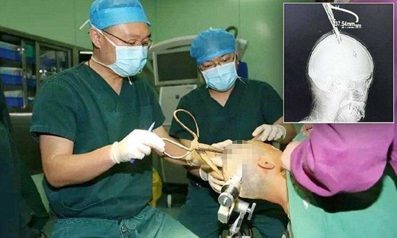 Китайские врачи извлекли из головы женщины гигантские ножницы