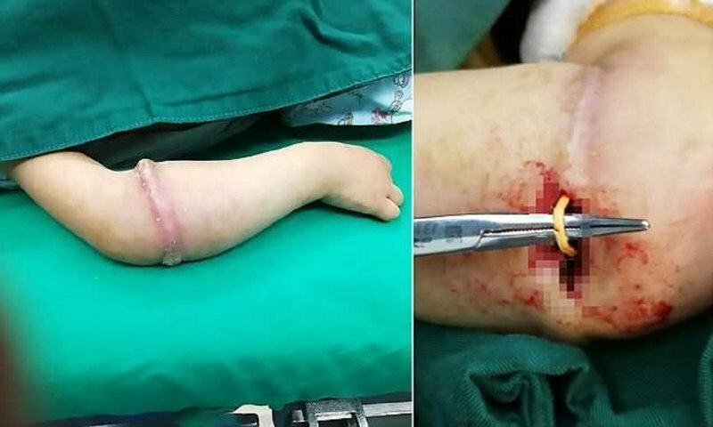 Китайским врачам пришлось хирургически удалять резиновое кольцо, вросшее ребенку под кожу