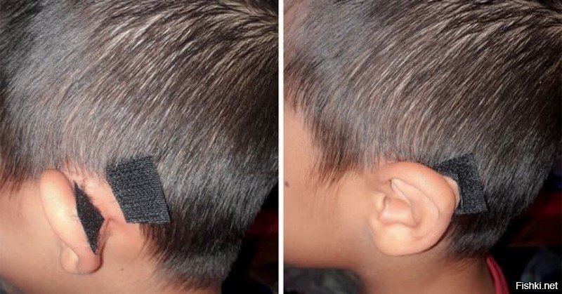 Дешевле, чем отопластика