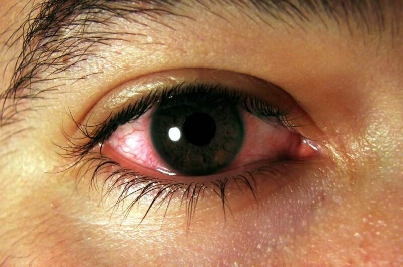 Почему краснеют глаза: причины появления симптома