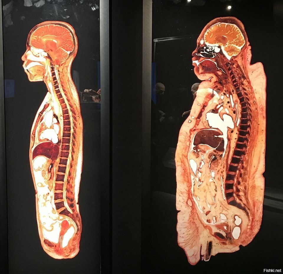 Экспонат выставки "Body Worlds" немецкого анатома Гунтера фон Хагенса