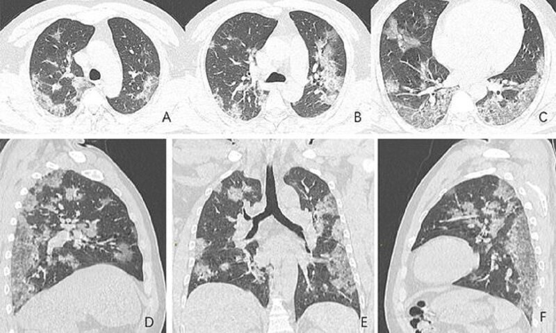 Рентген показал, что коронавирус делает с человеческими легкими