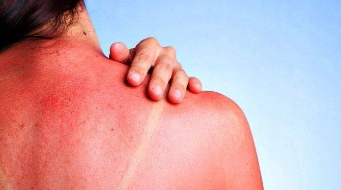 Чтобы солнце было в радость: несколько действенных советов