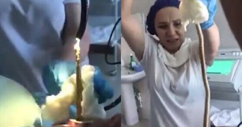 Видео из операционной: изо рта россиянки медики извлекли огромную змею