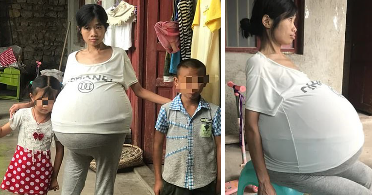 Из-за рака яичников у китаянки вырос 40-килограммовый живот