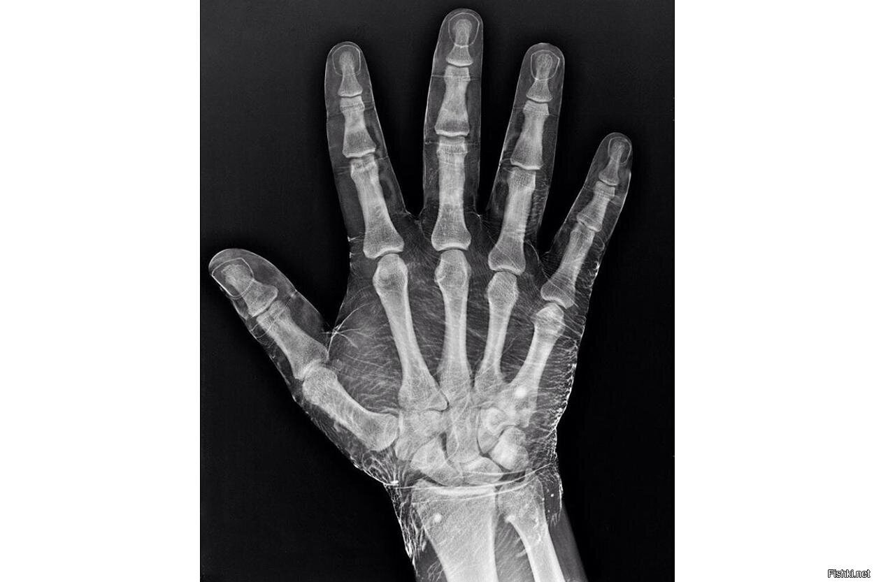 Рентген руки, смоченной в йоде