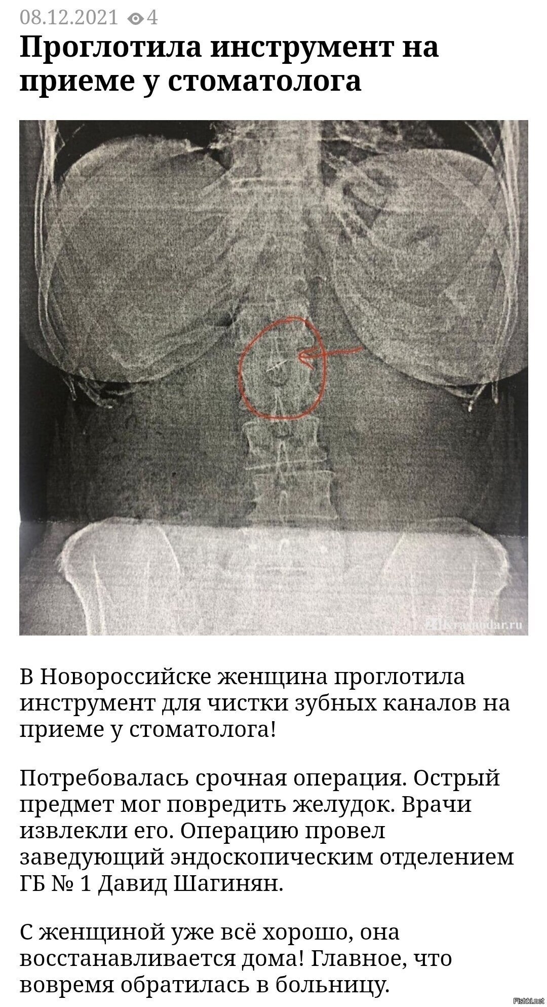 Чистка каналов зуба оказывается очень опасная процедура