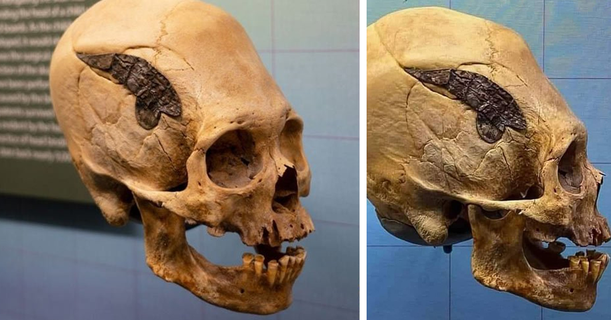 Металлическую пластину в голове перуанского воина назвали древнейшей операцией на черепе