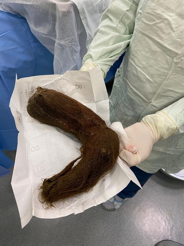 Хирурги больницы им. Сперанского извлекли из желудка подростка 1,5 кг волос⁠⁠
