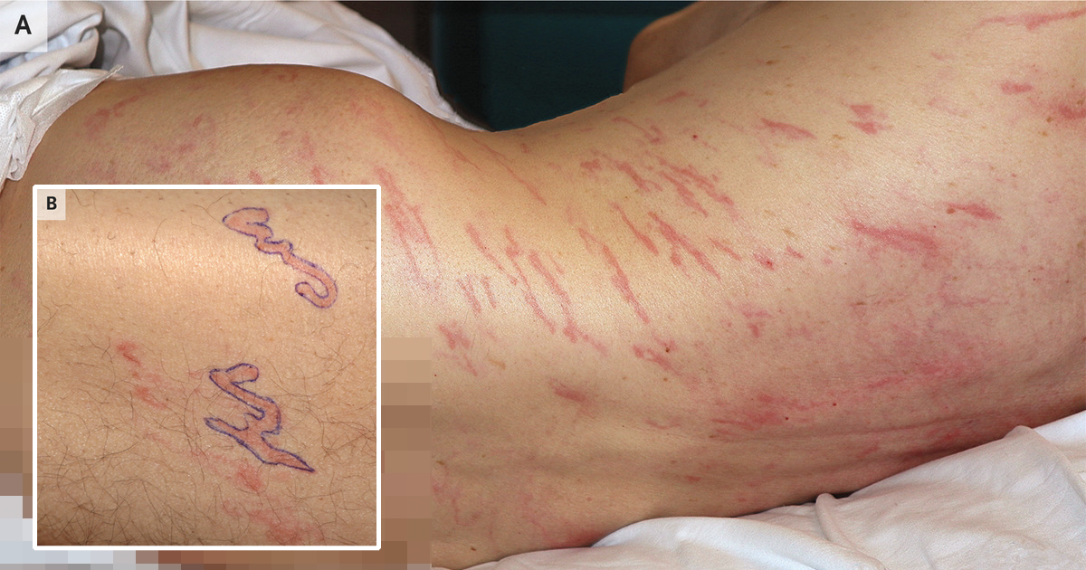 Испанец попал в больницу с редким заболеванием: врачи нашли у него червей под кожей