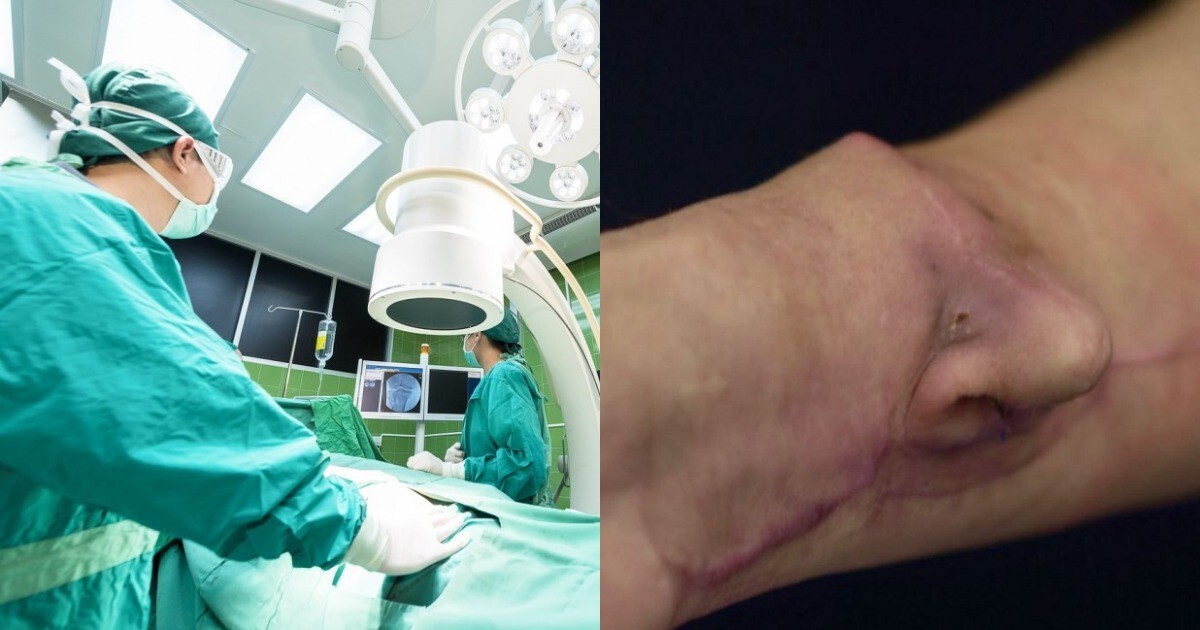 Пластические хирурги из Беларуси вырастили нос на руке