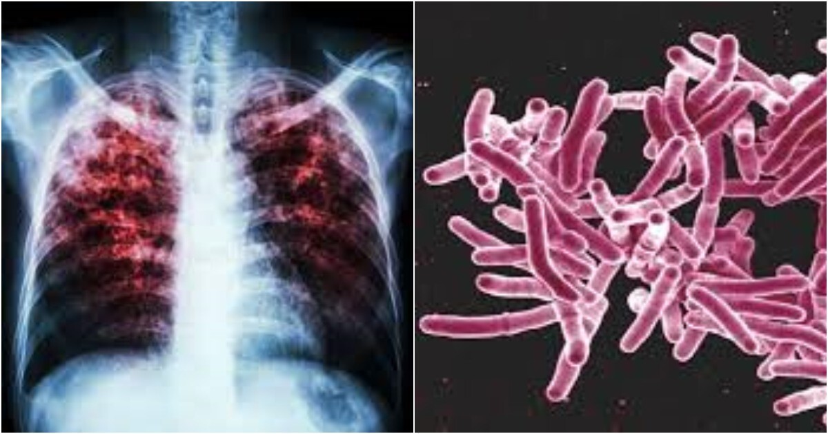 Новый штамм туберкулеза бушует в США и Великобритании