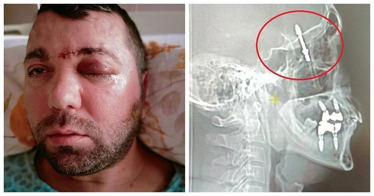 В Турции стоматолог вкрутил зубной имплант в полость мозга пациента и сбежал