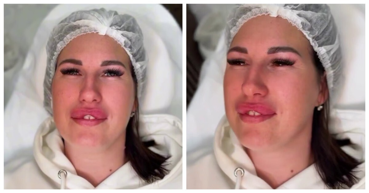 Как выглядит эффект «заячьих губок»