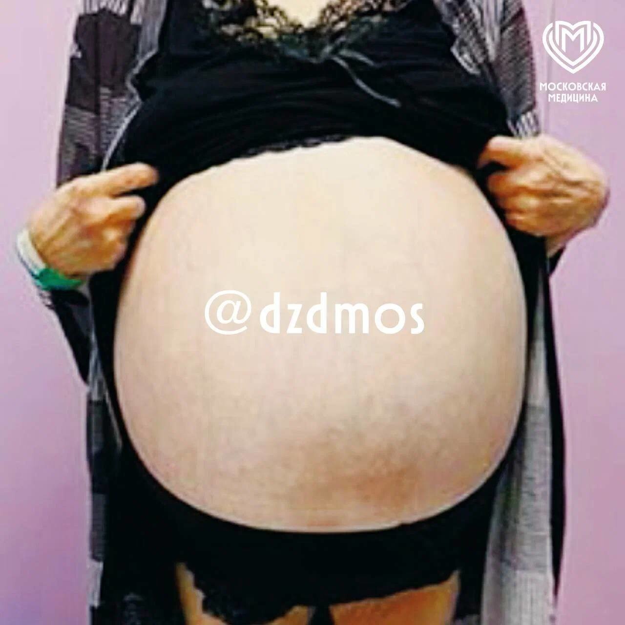 Женщина более 15 лет не ходила к врачу. Итог: гигантская опухоль весом 30 кг⁠