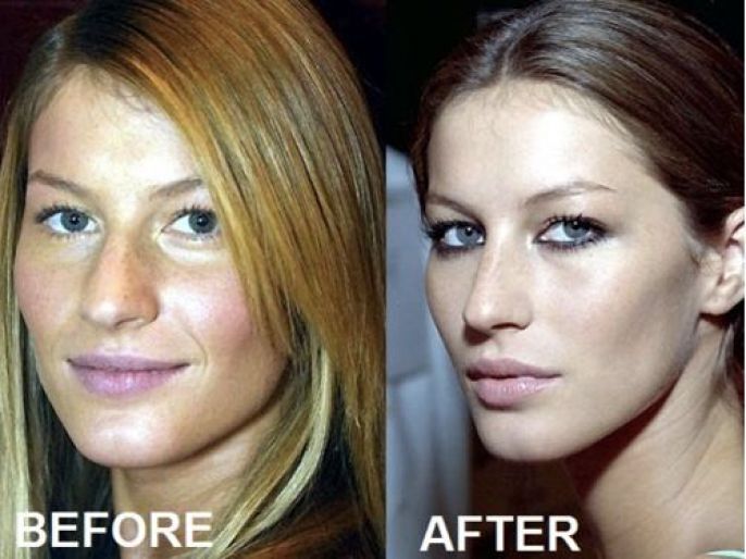 Plastic Surgery Before And After 