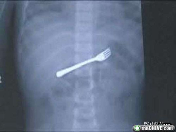 Scary X-ray Fork In Body